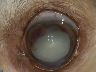 Перезрелая катаракта, вывих хрусталика: фото