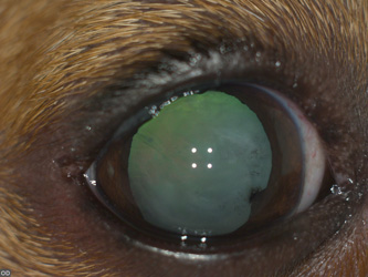 Задняя синехия при катаракте, фото