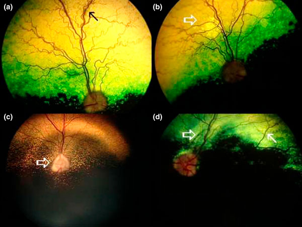 Рак-ассоциированная ретинопатия - глазное дно