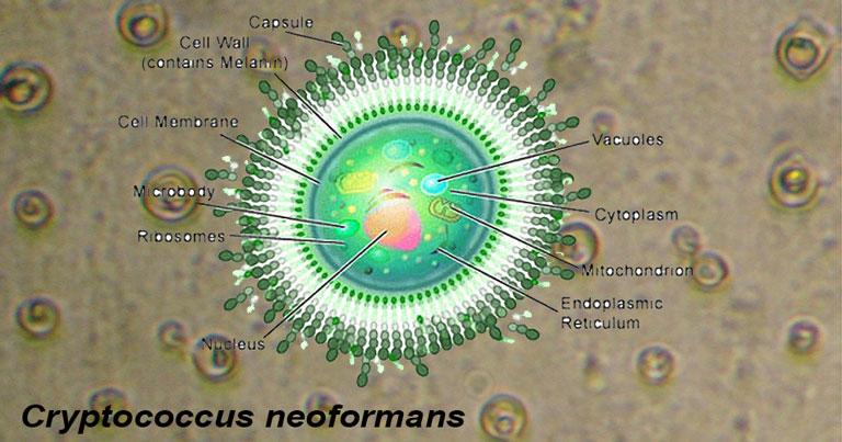 Остиомиелит клиновидной кости. Cryptococcus neoformans var. neoformans - заход